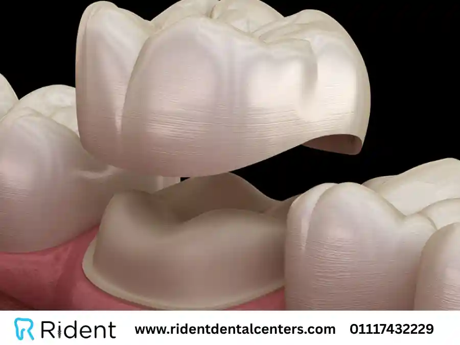 أنواع كراون الاسنان